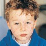 Molluskum contagiosum hos barn Molluskum contagiosum hos barn
