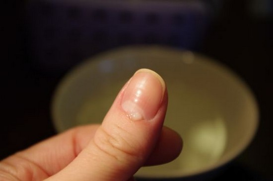 Cuticle fjerning
