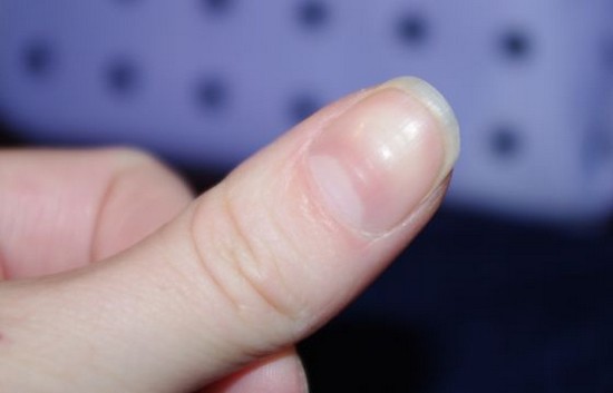 Cuticle fjerning