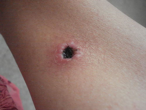 Hva er en fistel? Symptomer, bilder, fistelbehandling