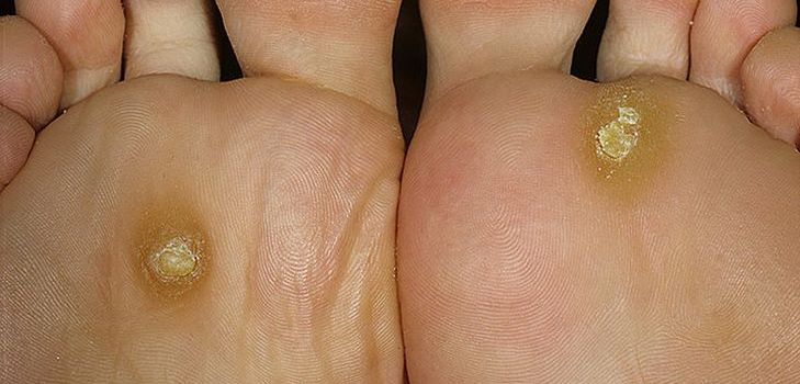 Problemer med corns og calluses? Se etter løsningen her!