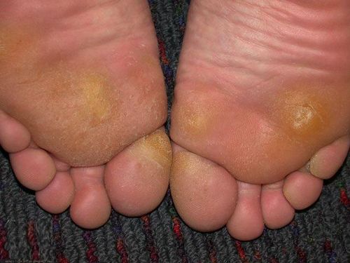 Problemer med corns og calluses? Se etter løsningen her!