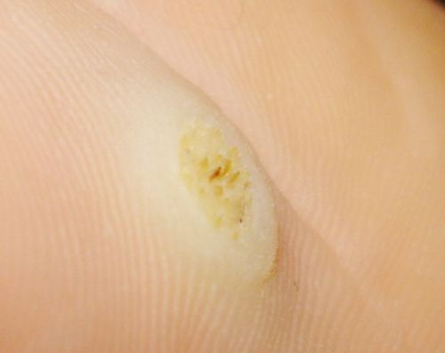Problemer med corns og calluses? Se etter løsningen her!