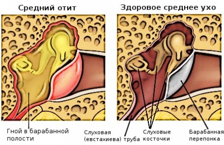 Hvordan behandle otitis i hjemmet?