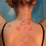 Hvordan behandle psoriasis? Hvordan behandle psoriasis?