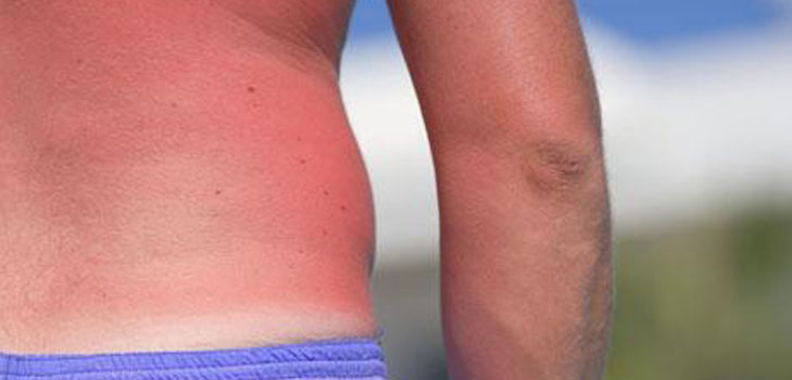 Huden er scorched i solen. Hva skal jeg gjøre? Oppskrifter, masker, tips