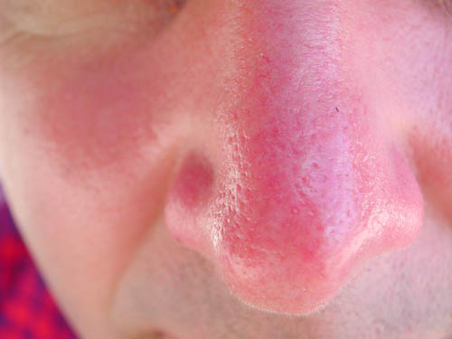 Huden er scorched i solen. Hva skal jeg gjøre? Oppskrifter, masker, tips