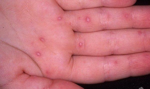 Utslett hos voksne: bilder, årsakene til utslett og tips for behandling av hudutslett
